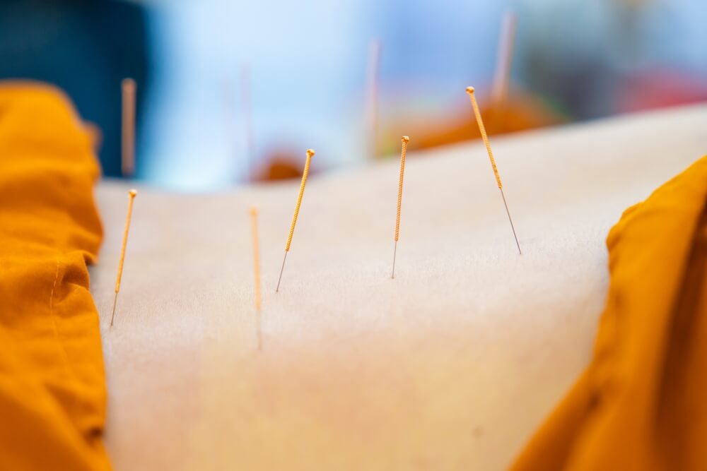 traitement par acupuncture